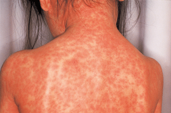 麻疹の皮膚変化
